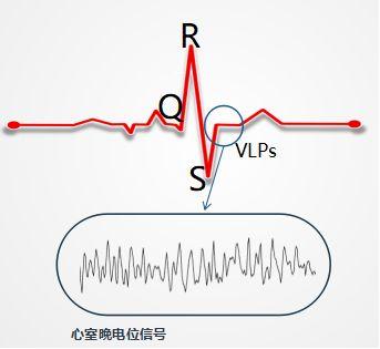 容易被身体忽视的危险信号——心室晚电位