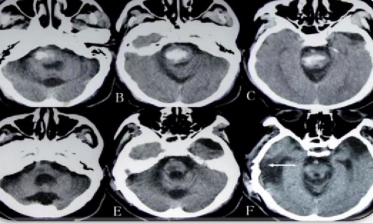 华志医疗——神经外科手术机器人技术领航者